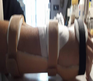 Νάρθηκας πηχεοκαρπικής